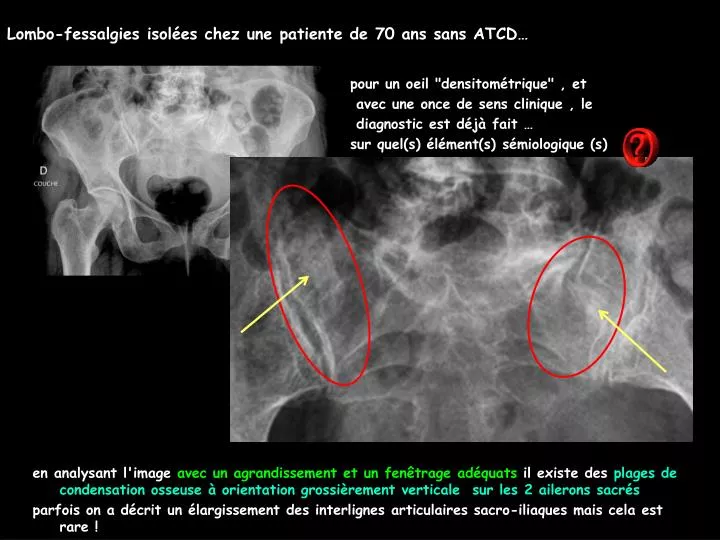 lombo fessalgies isol es chez une patiente de 70 ans sans atcd