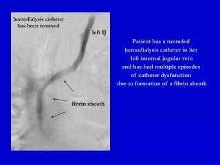 Patient has a tunneled hemodialysis catheter in her left internal jugular vein and has had multiple episodes of cathe