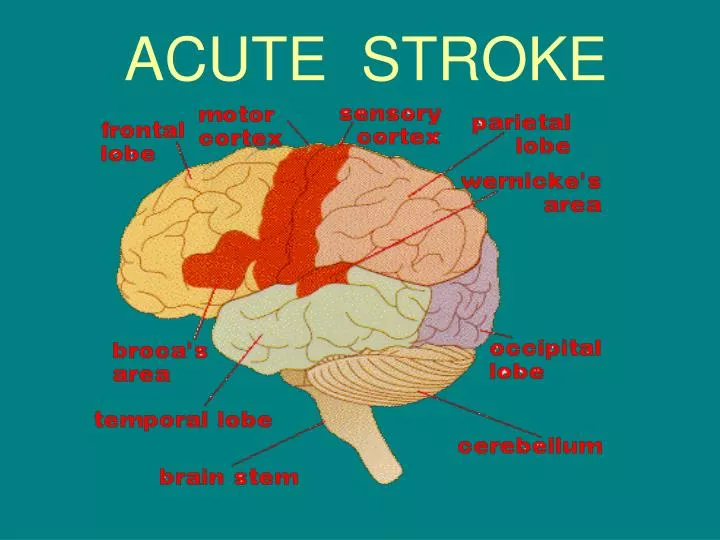 acute stroke