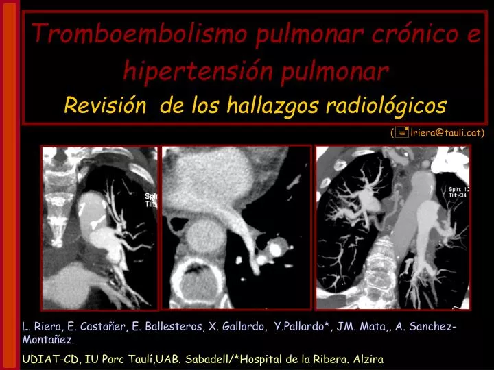 tromboembolismo pulmonar cr nico e hipertensi n pulmonar revisi n de los hallazgos radiol gicos