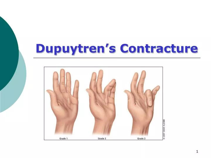 dupuytren s contracture