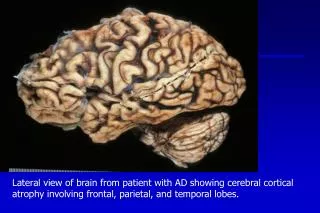 Lateral view of brain from patient with AD showing cerebral cortical atrophy involving frontal, parietal, and temporal l