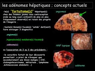 les adénomes hépatiques ; concepts actuels