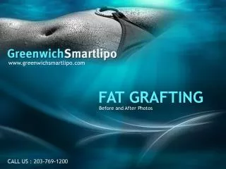 Fat Grafting