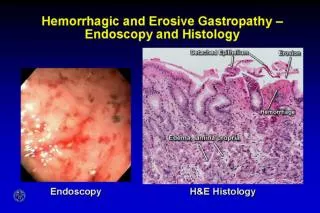 Hemorrhagic and Erosive Gastropathy - Endoscopy and Histology