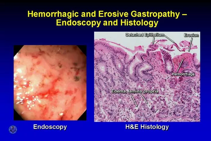 hemorrhagic and erosive gastropathy endoscopy and histology