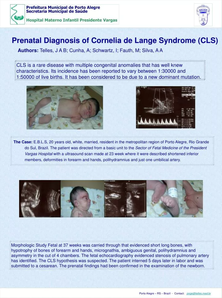 prenatal diagnosis of cornelia de lange syndrome cls