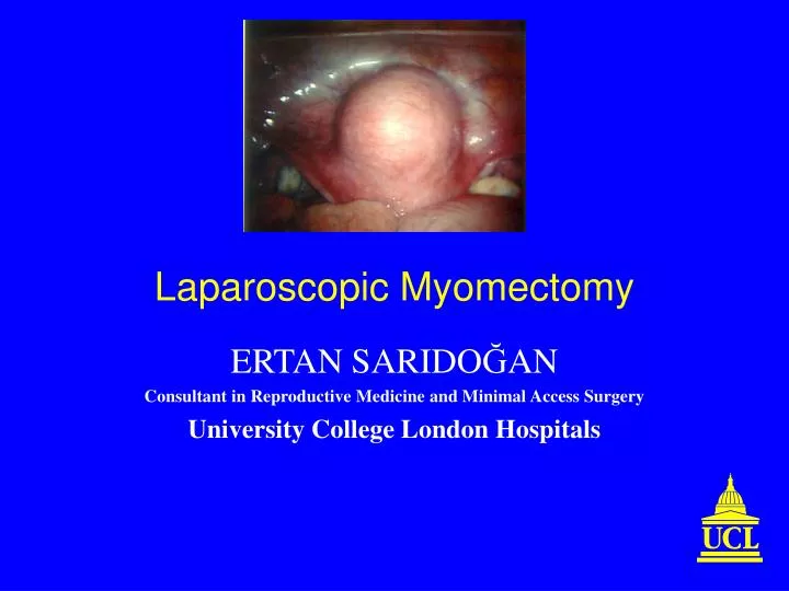 laparoscopic myomectomy