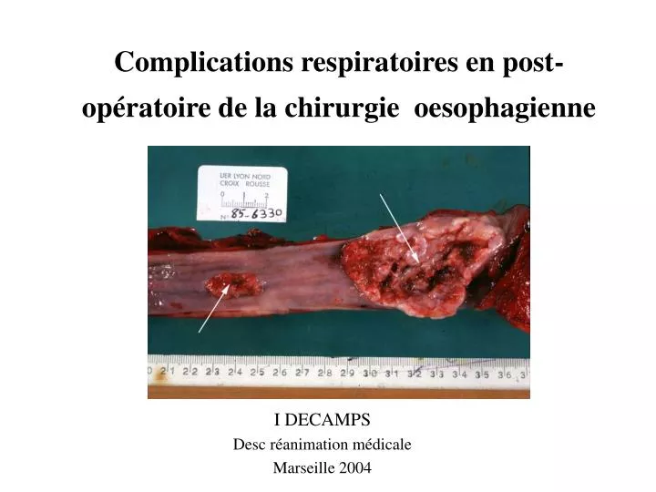 complications respiratoires en post op ratoire de la chirurgie oesophagienne