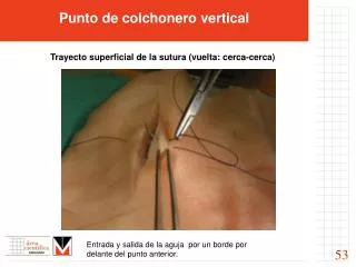 Punto de colchonero vertical Trayecto superficial de la sutura (vuelta: cerca-cerca)