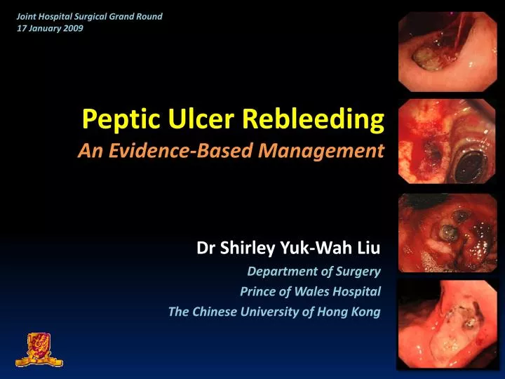 peptic ulcer rebleeding an evidence based management