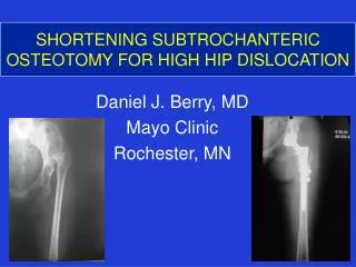 SHORTENING SUBTROCHANTERIC OSTEOTOMY FOR HIGH HIP DISLOCATION