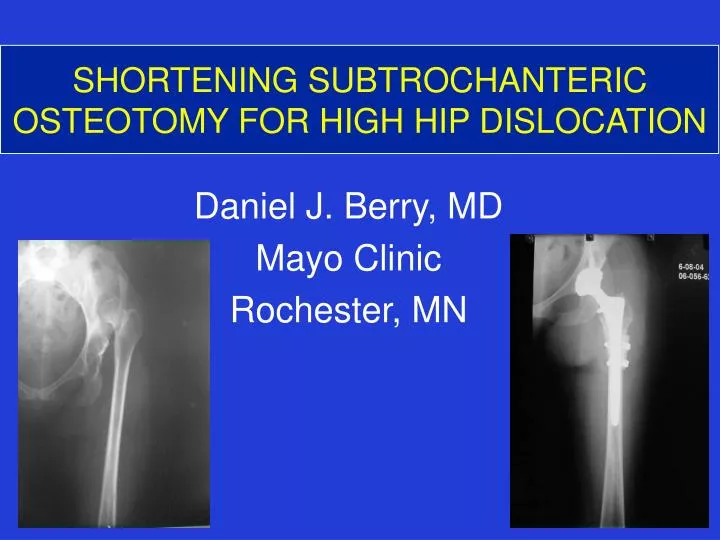 shortening subtrochanteric osteotomy for high hip dislocation