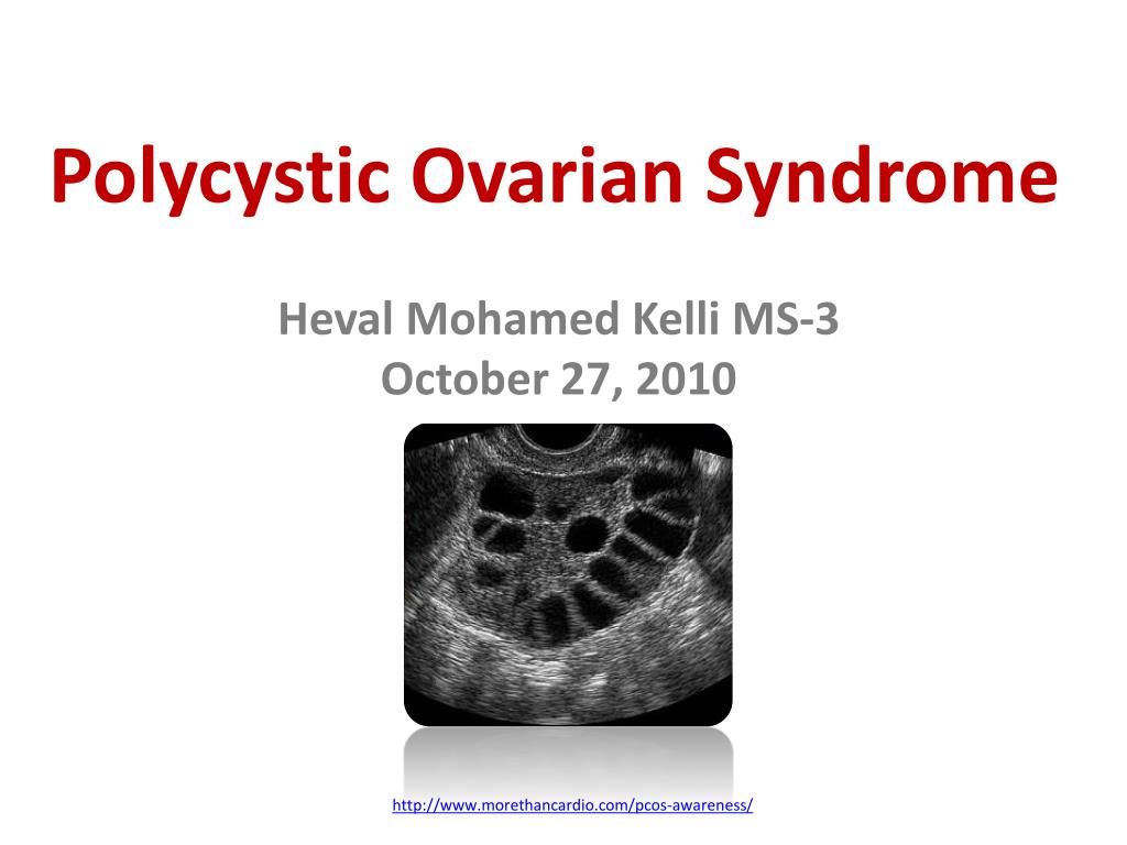 PPT - Polycystic Ovarian Syndrome PowerPoint Presentation, free ...