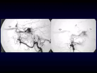 Dural Arteriovenous Fistulae Static or Dynamic?