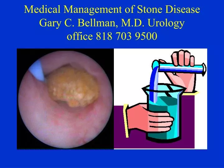 medical management of stone disease gary c bellman m d urology office 818 703 9500