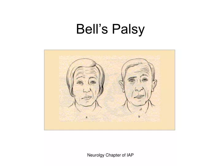 bell s palsy