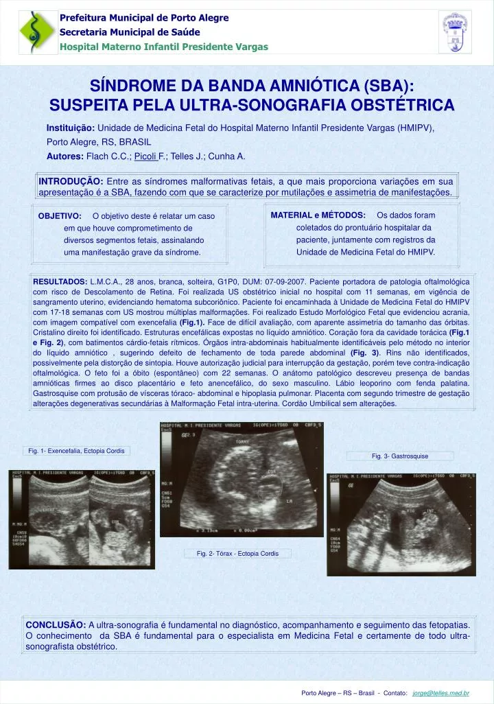 s ndrome da banda amni tica sba suspeita pela ultra sonografia obst trica