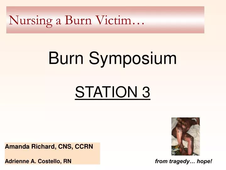 nursing a burn victim