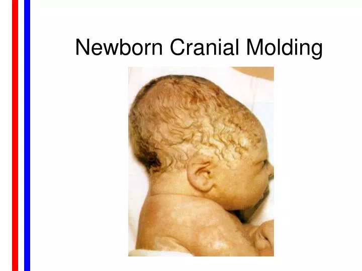 newborn cranial molding