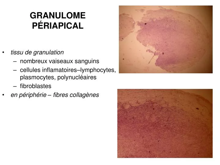 granulome p riapical