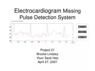 Electrocardiogram Missing Pulse Detection System