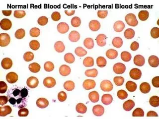 Normal Red Blood Cells - Peripheral Blood Smear