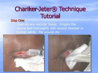 Chariker-Jeter® Technique Tutorial