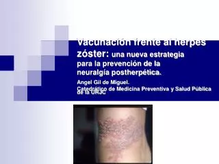 La varicela es una enfermedad exantemática de distribución mundial producida por la infección del virus varicela zoster