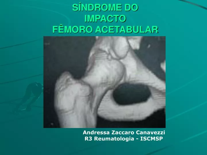 s ndrome do impacto f moro acetabular