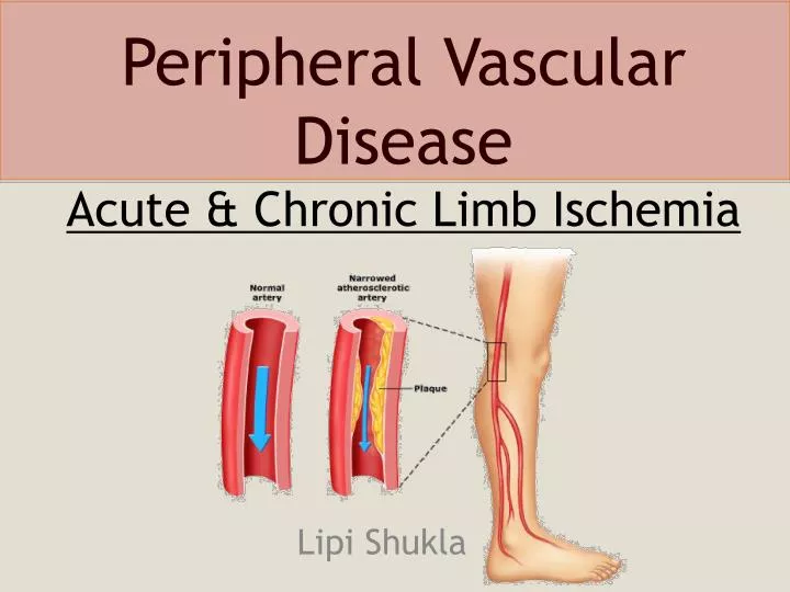 peripheral vascular disease acute chronic limb ischemia