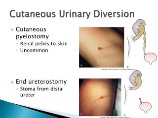 Cutaneous Urinary Diversion