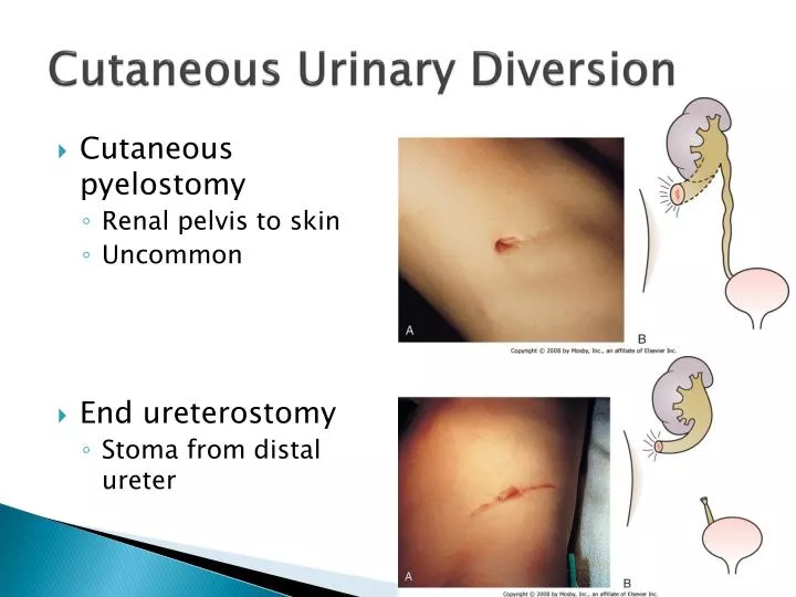 cutaneous urinary diversion