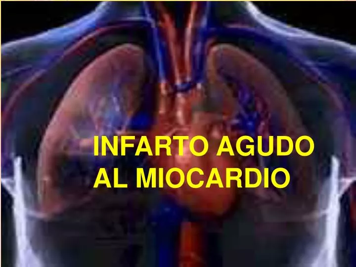 infarto agudo al miocardio