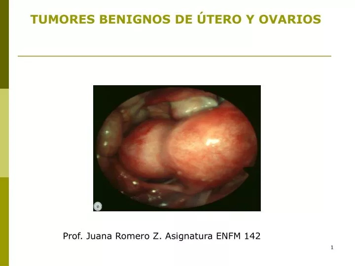 tumores benignos de tero y ovarios