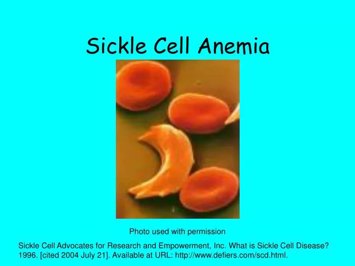 sickle cell anemia