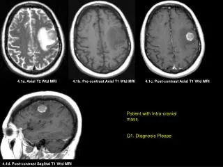 4.1b. Pre-contrast Axial T1 Wtd MRI
