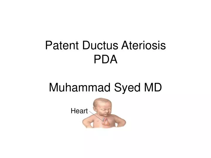 patent ductus ateriosis pda muhammad syed md