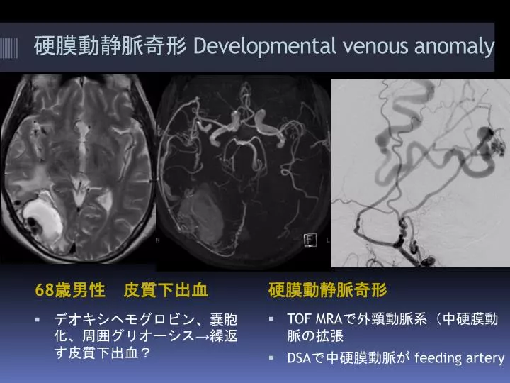 developmental venous anomaly