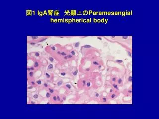 図 1 IgA 腎症　光顕上の Paramesangial hemispherical body