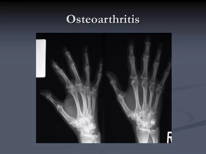 osteoarthritis