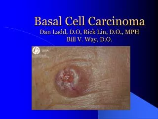 Basal Cell Carcinoma Dan Ladd, D.O, Rick Lin, D.O., MPH Bill V. Way, D.O.