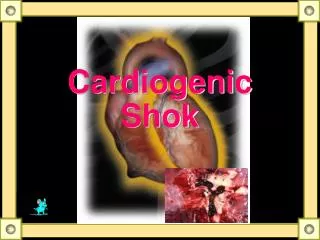 Cardiogenic Shok