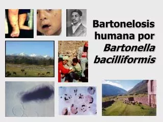 Bartonelosis humana por Bartonella bacilliformis