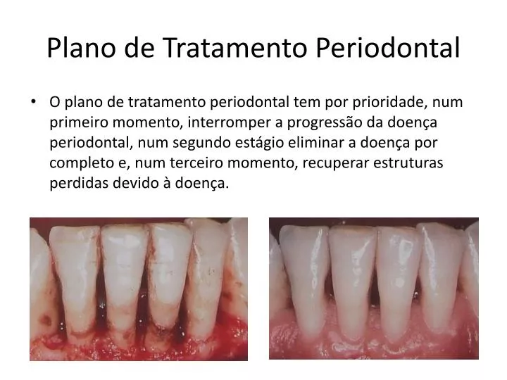 plano de tratamento periodontal