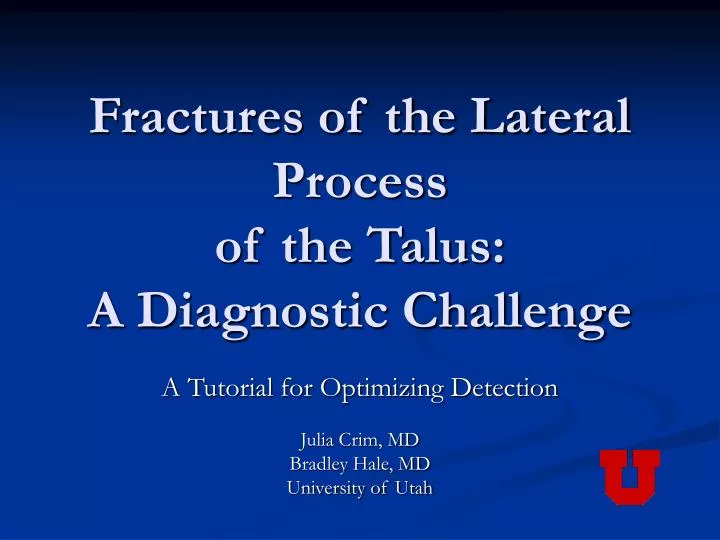 fractures of the lateral process of the talus a diagnostic challenge