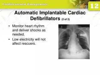 Automatic Implantable Cardiac Defibrillators (2 of 2)