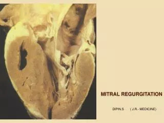 MITRAL REGURGITATION