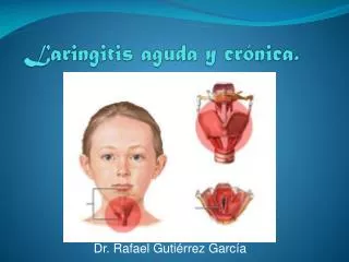 Laringitis aguda y crónica.