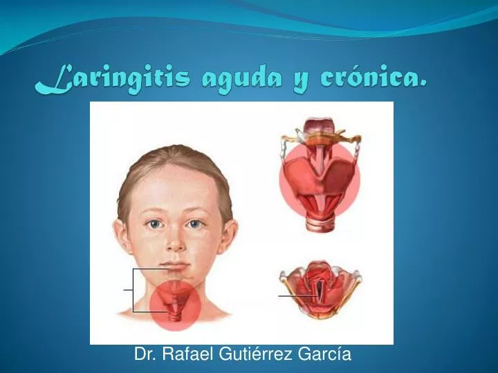 laringitis aguda y cr nica